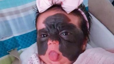 Фото - Девочку из США с врождённой «маской Бэтмена» спасут российские врачи