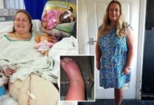 Фото - Женщина с синдромом Зудека попросила об ампутации ноги