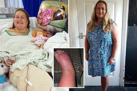 Фото - Женщина с синдромом Зудека попросила об ампутации ноги
